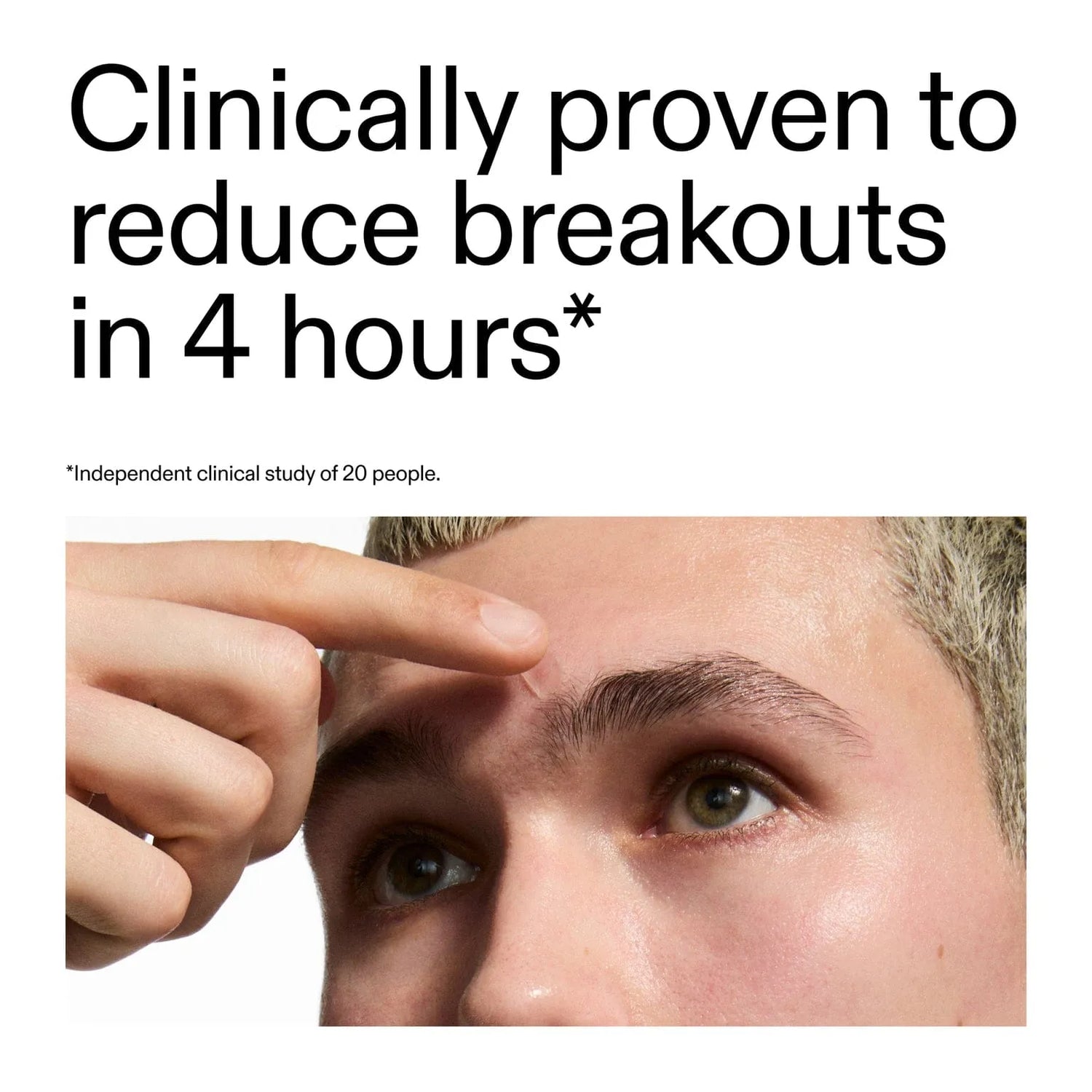 Hydrocolloid Pimple Patches results image